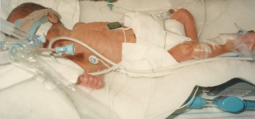 My Story.. As A Baby In The NICU